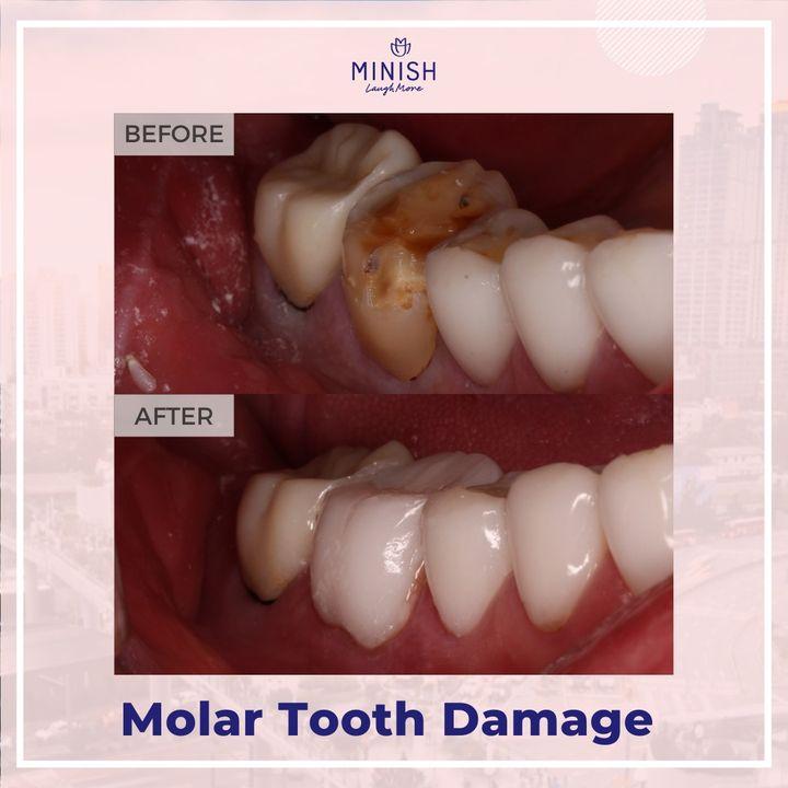 Before and After Veneers
