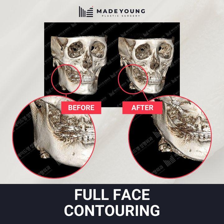 Before and After Square Jaw Surgery