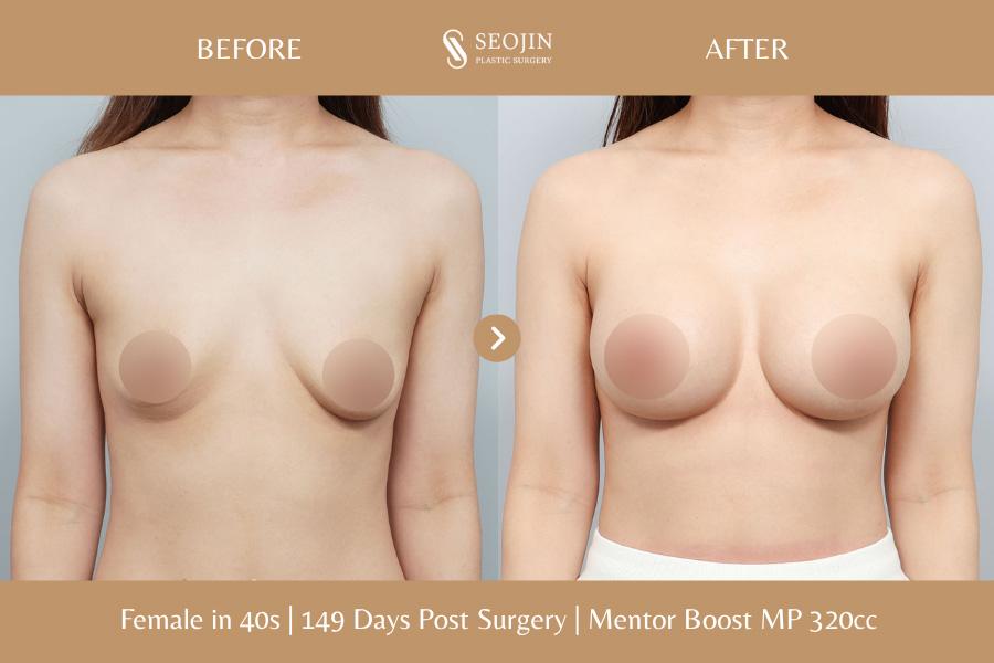Before and After Breast Augmentation