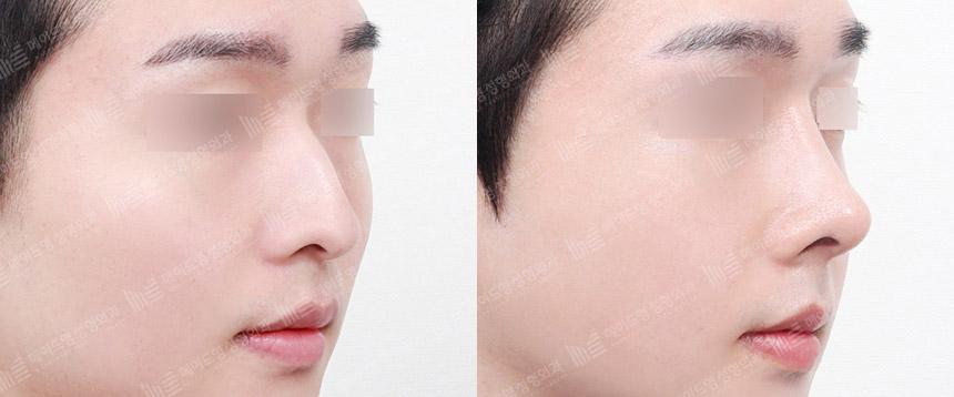 Before and After Rhinoplasty