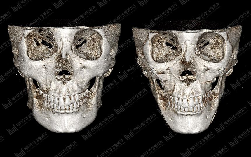 Before and After Face Contouring