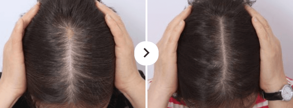 Before and After Hair Loss Treatment
