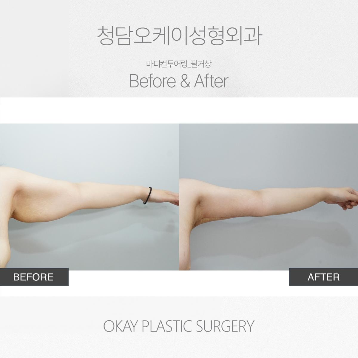 Before and After Arm Lift