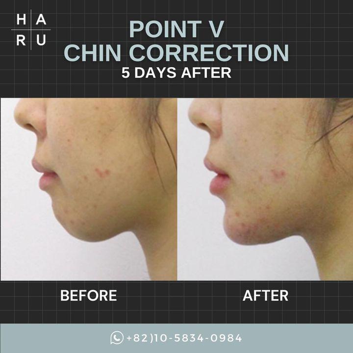 Before and After Chin Surgery