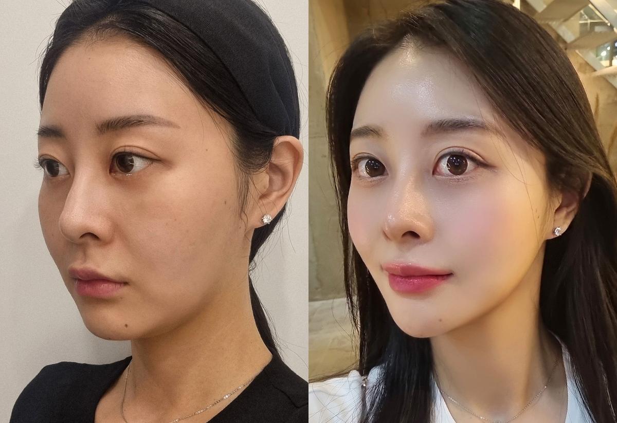 Before and After Thread Lift