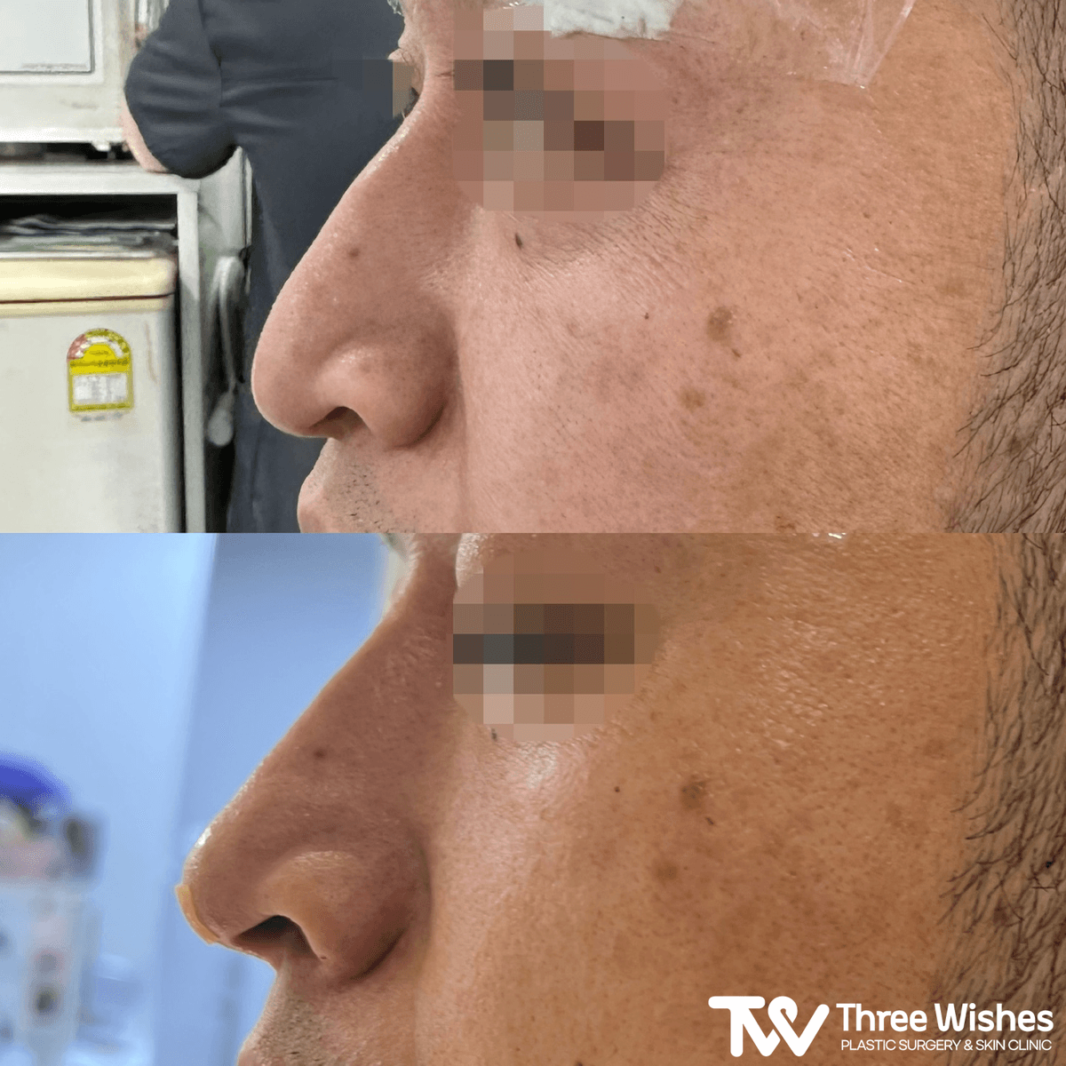 Before and After Hiko Nose Thread Lift