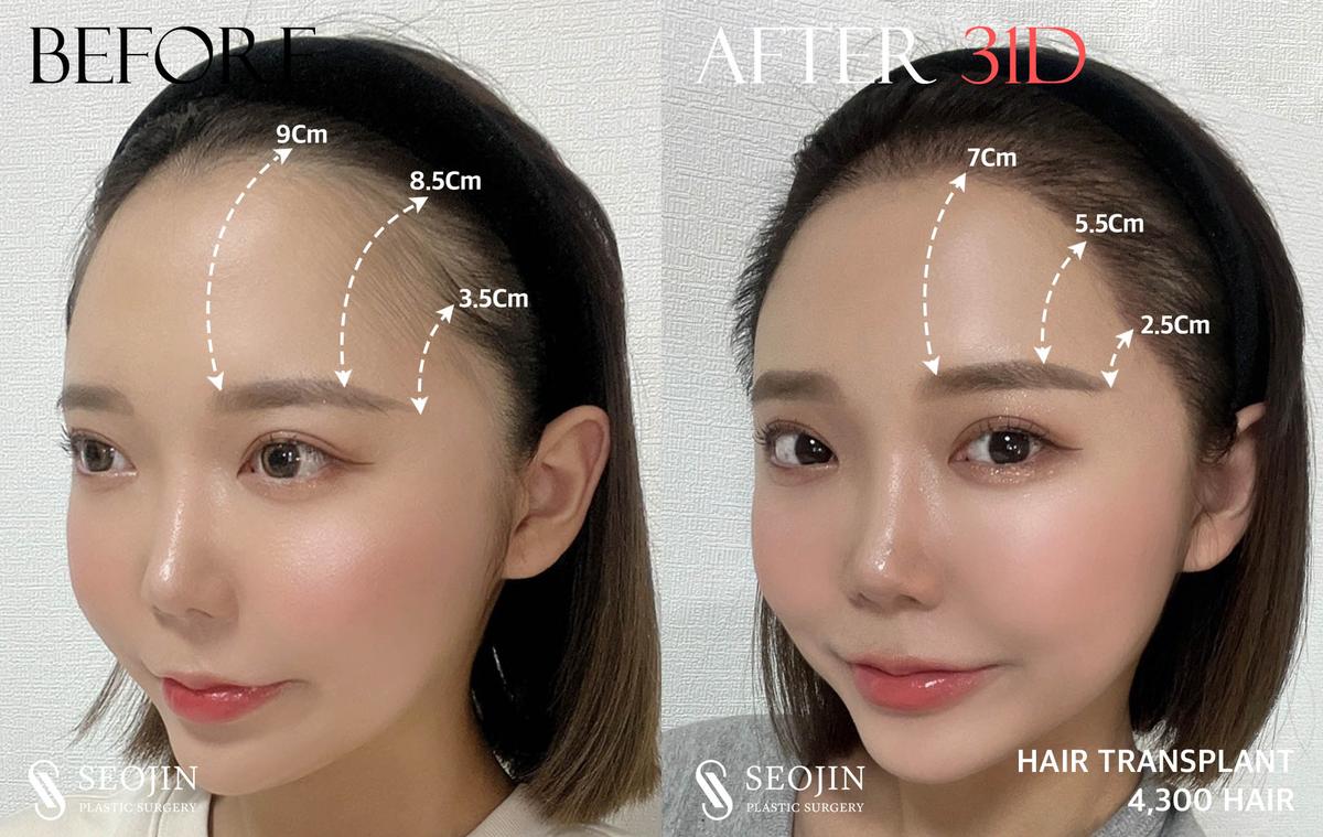 Before and After Hairline Correction