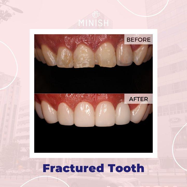 Before and After Veneers