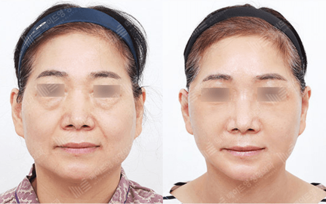 Before and After Face Lift