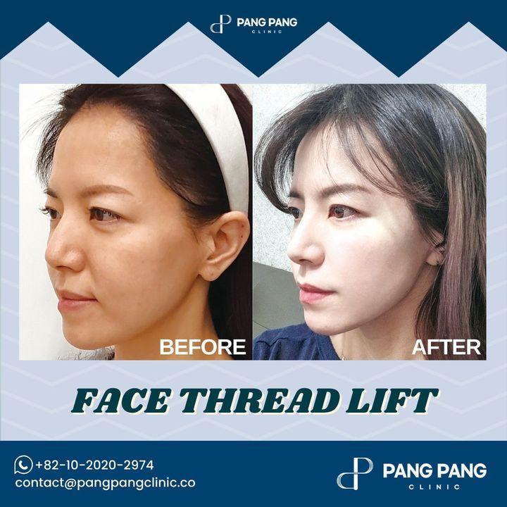 Before and After Thread Lift