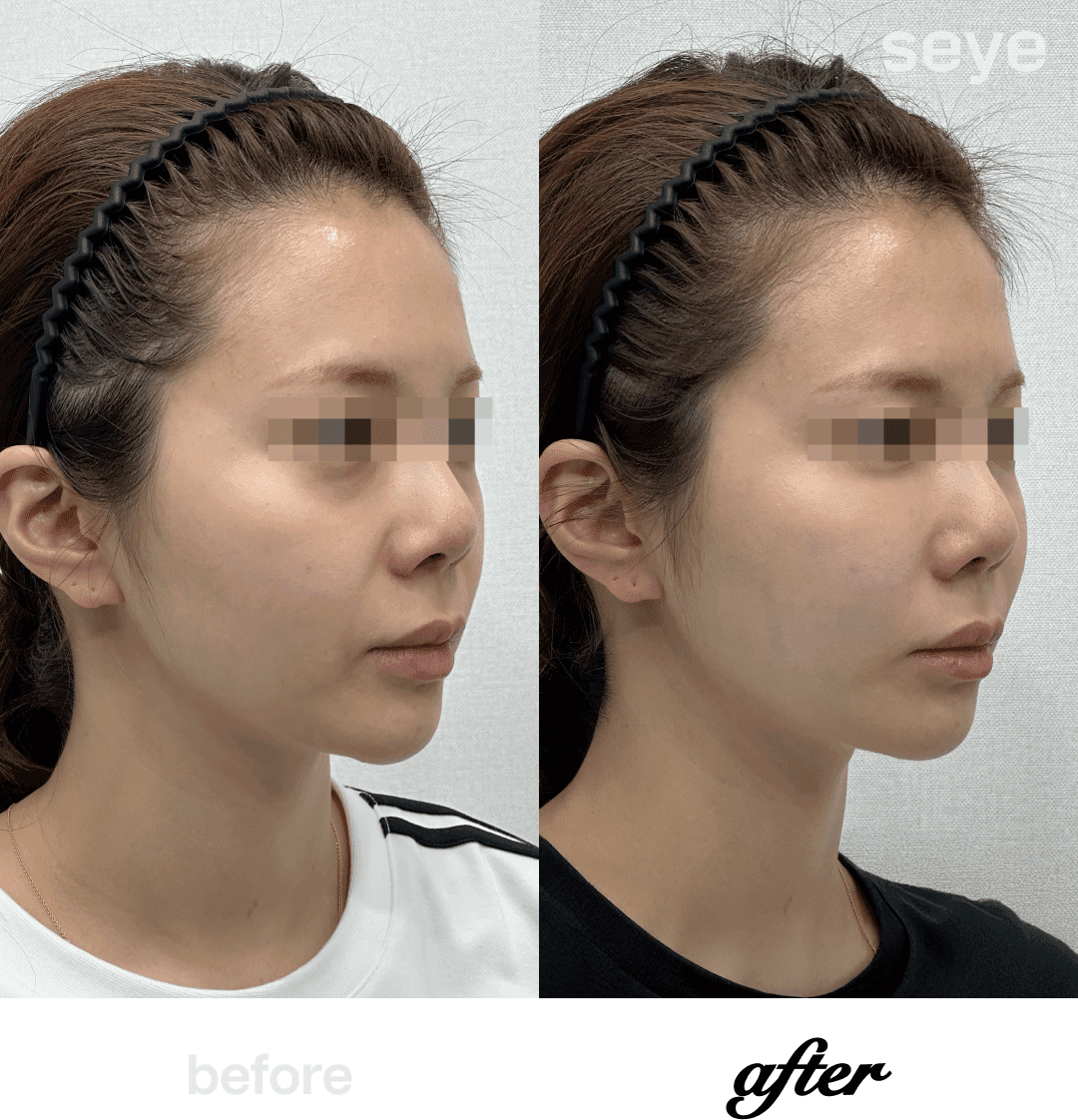 Before and After Skin Booster