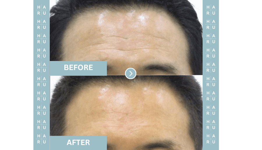 Before and After Forehead Filler