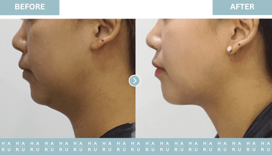 Before and After Face Thread Lift
