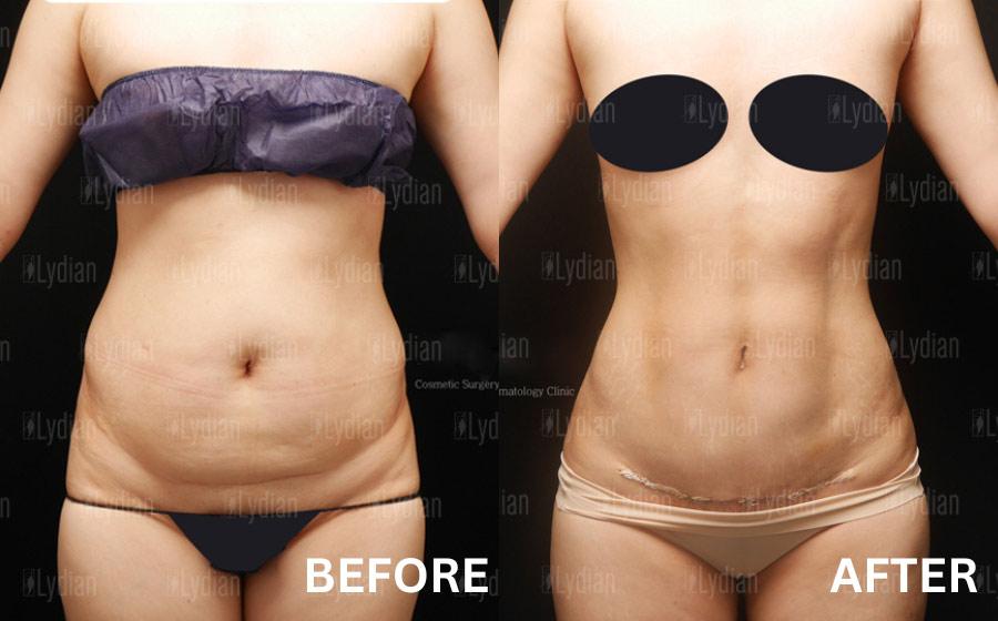 Before and After Tummy Tuck