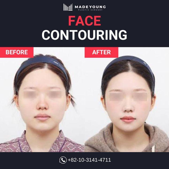 Before and After Face Contouring