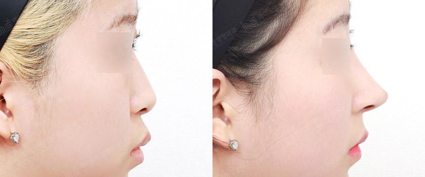 Before and After Rhinoplasty