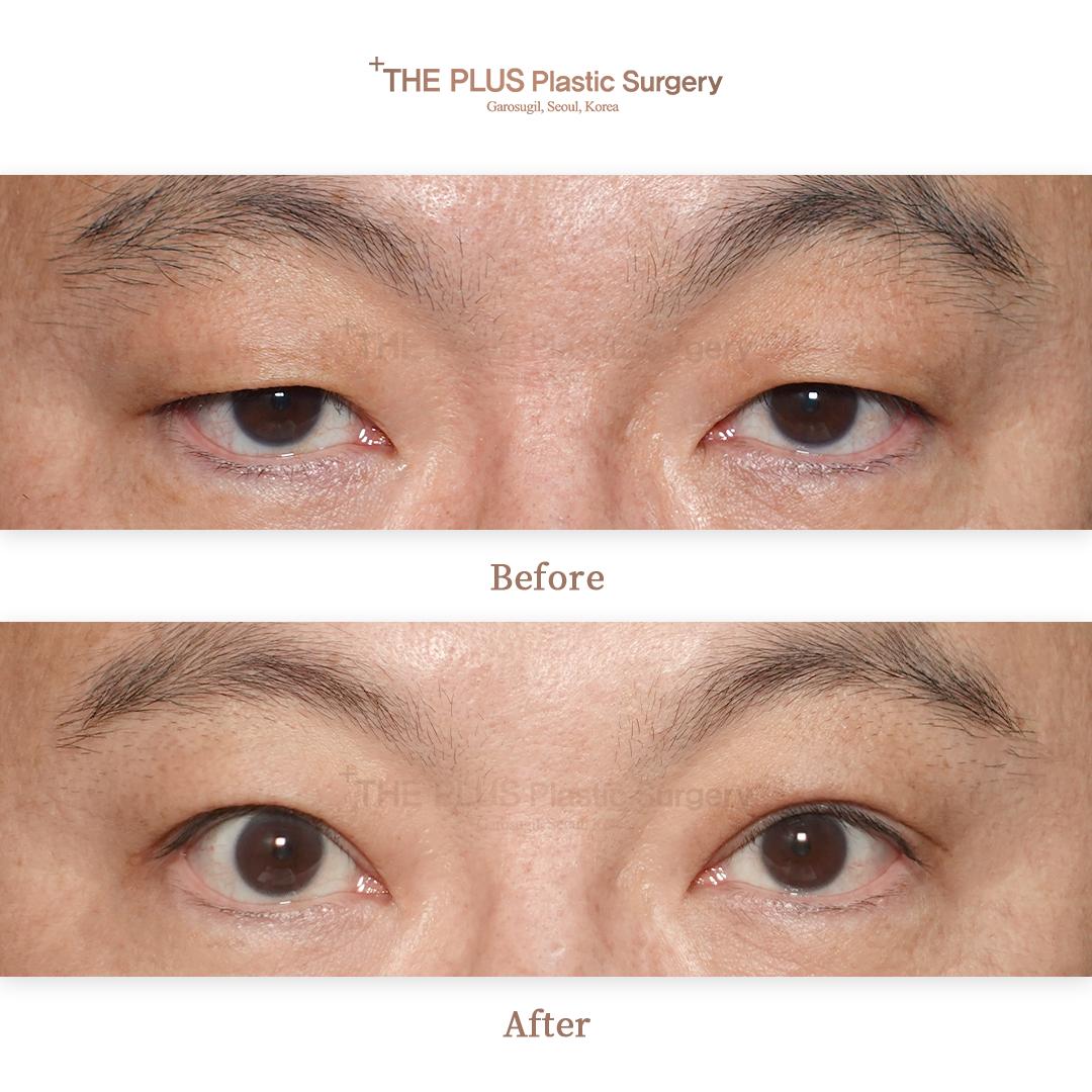 Before and After Blepharoplasty