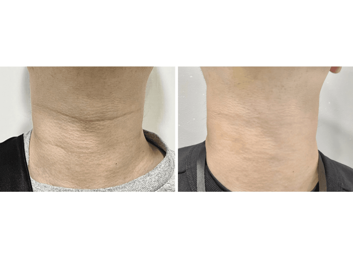 Before and After Neck Wrinkle Treatment