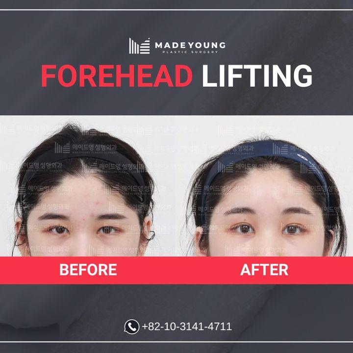 Before and After Thread Lift