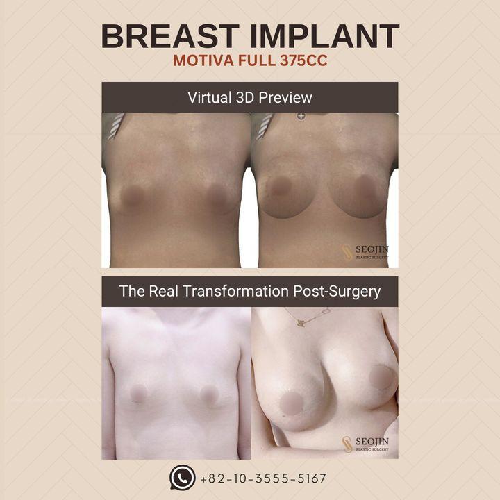 Before and After Breast Implant