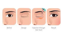 Love Band Surgery in Korea | Best Clinics, Costs, Procedure Types & More