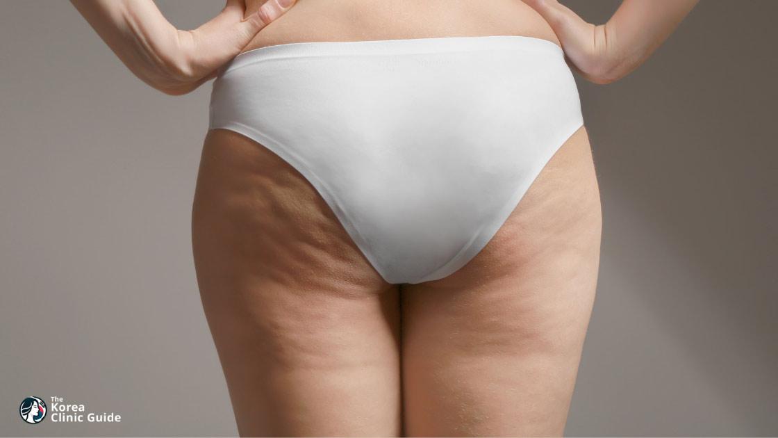 Eigenfetttransfer bei Hip Dips in Korea (Seoul | beste Kliniken, Kosten, Verfahrensarten und mehr)