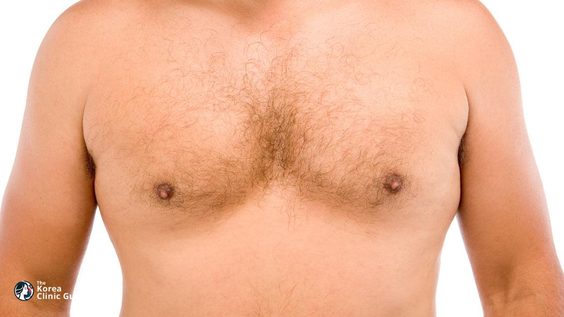 Gynäkomastie in Korea | Die besten Kliniken, Kosten, Eingriffsarten und mehr