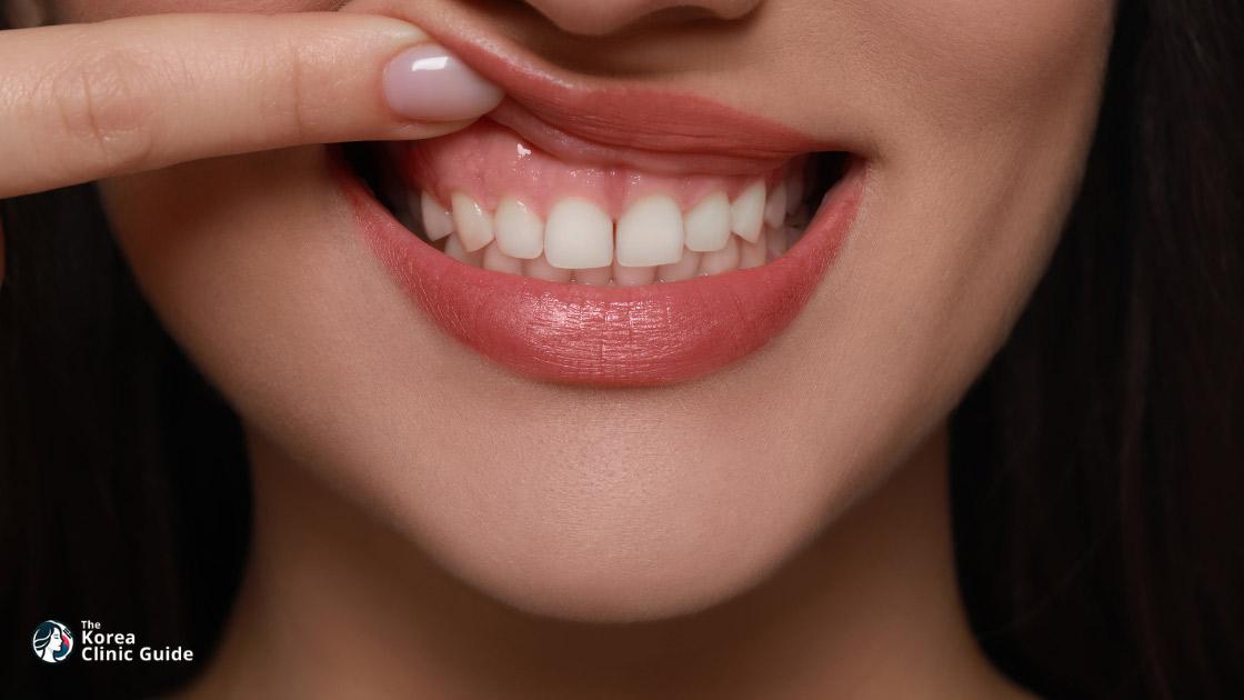 Botox beim Gummy Smile in Korea | Die besten Kliniken, Kosten, Behandlungsoptionen und mehr