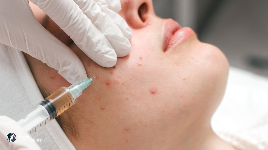 Stammzellbehandlung bei Aknenarben in Korea | Die besten Kliniken, Kosten, Behandlungsarten und mehr