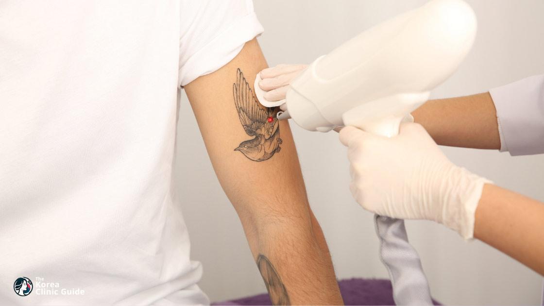 Laser-Tattooentfernung in Korea (Seoul) | Die besten Kliniken, Kosten, Behandlungsmethoden und mehr