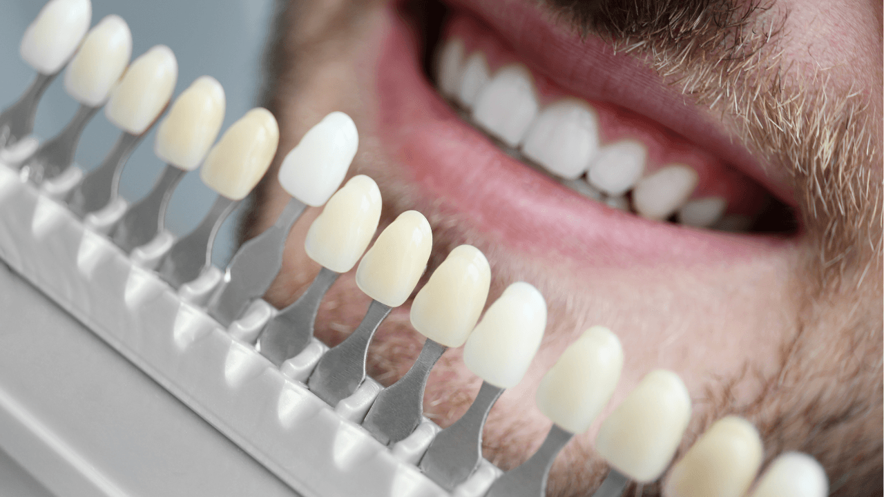 Veneers in Korea: Types, Treatment Timeline, Travel Planning and Aftercare
