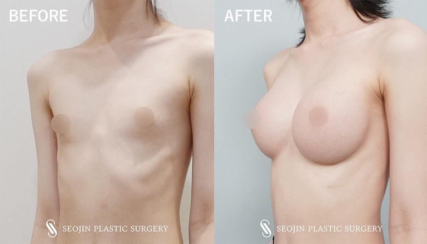 facial feminization surgery korea