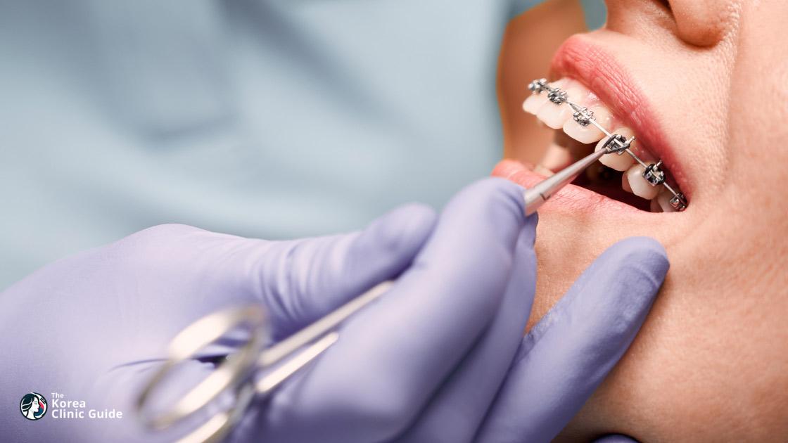 Clippy-C-Zahnspangen in Südkorea | Die besten Kliniken, Kosten, Behandlungsoptionen und mehr