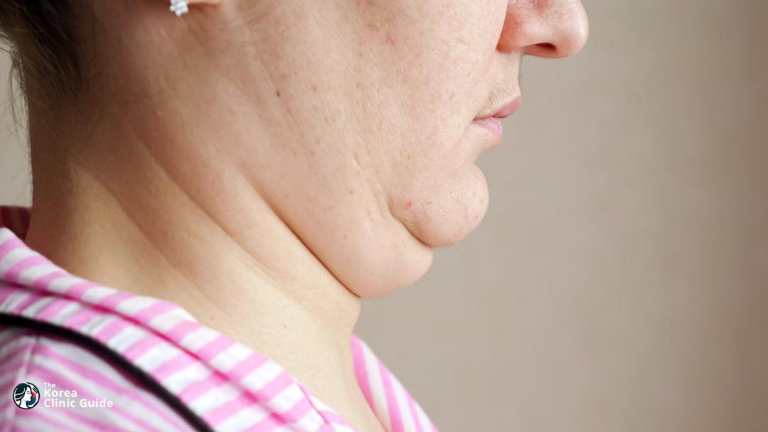 double chin tightening