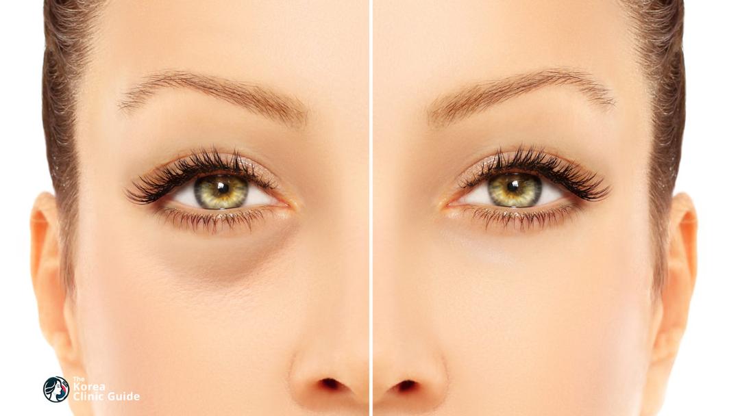 under eye fat grafting
