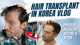 Hair Transplant in Korea Vlog │ Day 1 - 6 Months Recovery Journey at Maxwell Hair Transplant Clinic