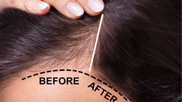 Hair Loss Treatment in Korea | Types, Best Clinics, Prices and More