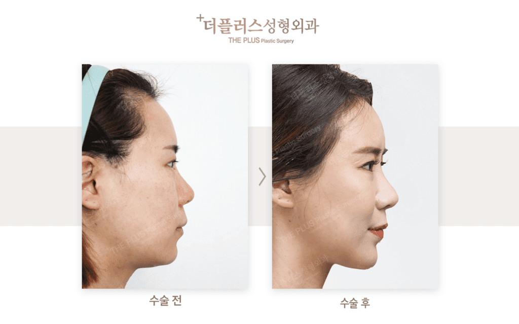 facial feminization surgery korea