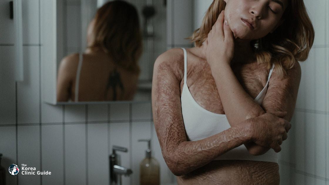 Behandlung von Verbrennungsnarben in Korea | Die besten Kliniken, Kosten, Behandlungsmethoden und mehr