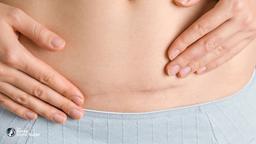 Scar Revision Surgery in Korea | Best Clinics, Costs, Procedure Types & More
