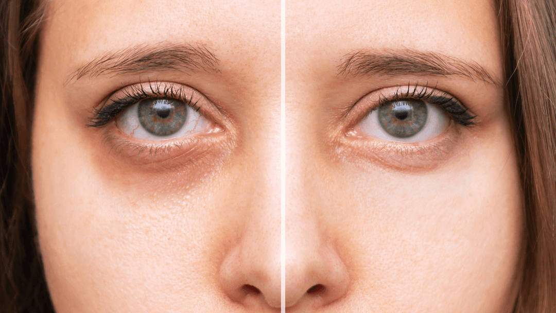 under eye filler