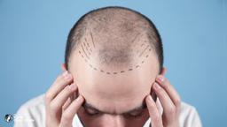 Hair Transplant in Korea | Costs, Best Clinics, Procedure Types & more