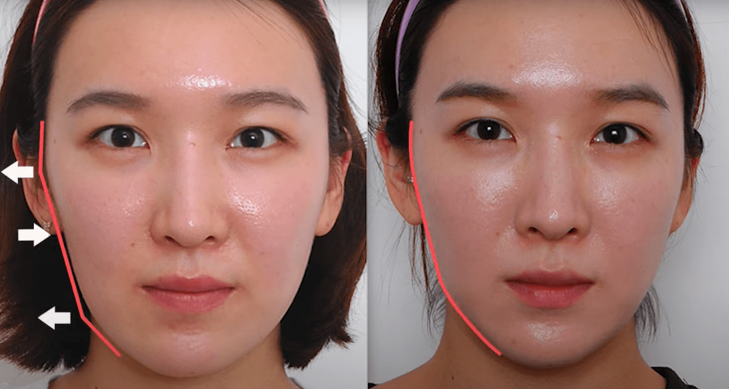 ultherapy review
