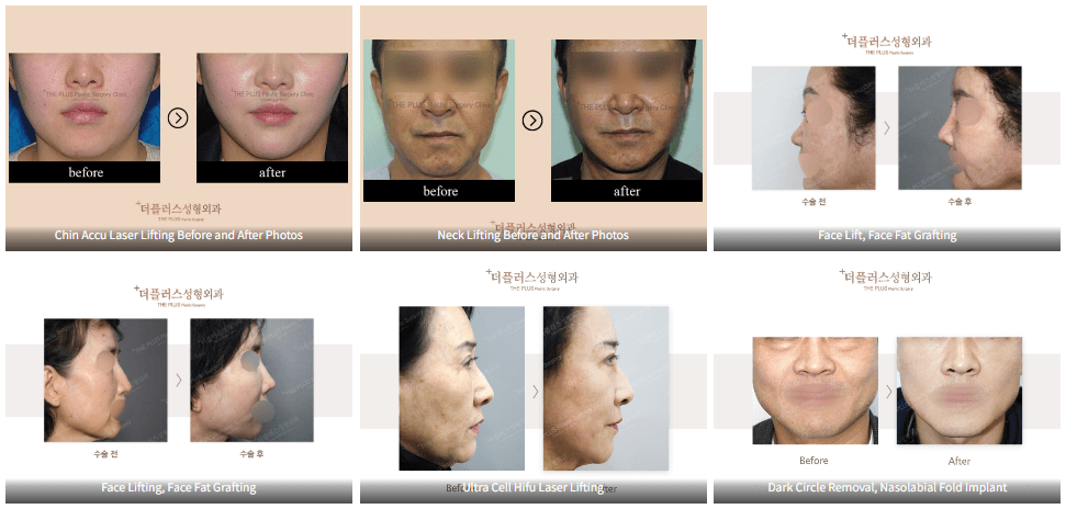 Facelift in Korea | Types of Facelift, Best Clinics & Costs