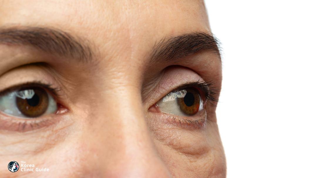 blepharoplasty