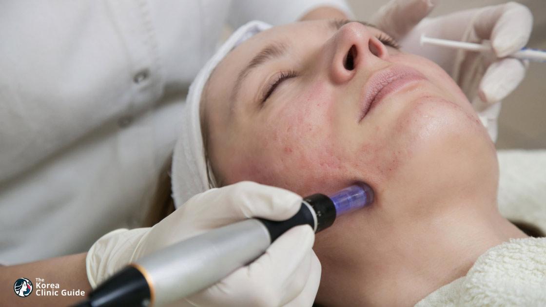 MTS-Gesichtsbehandlung in Korea | Die besten Kliniken, Kosten, Behandlungsarten und mehr