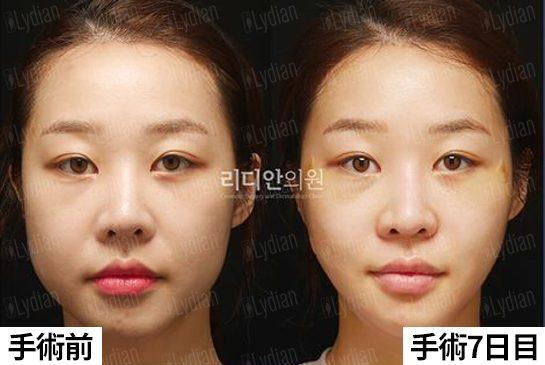facial feminization surgery korea