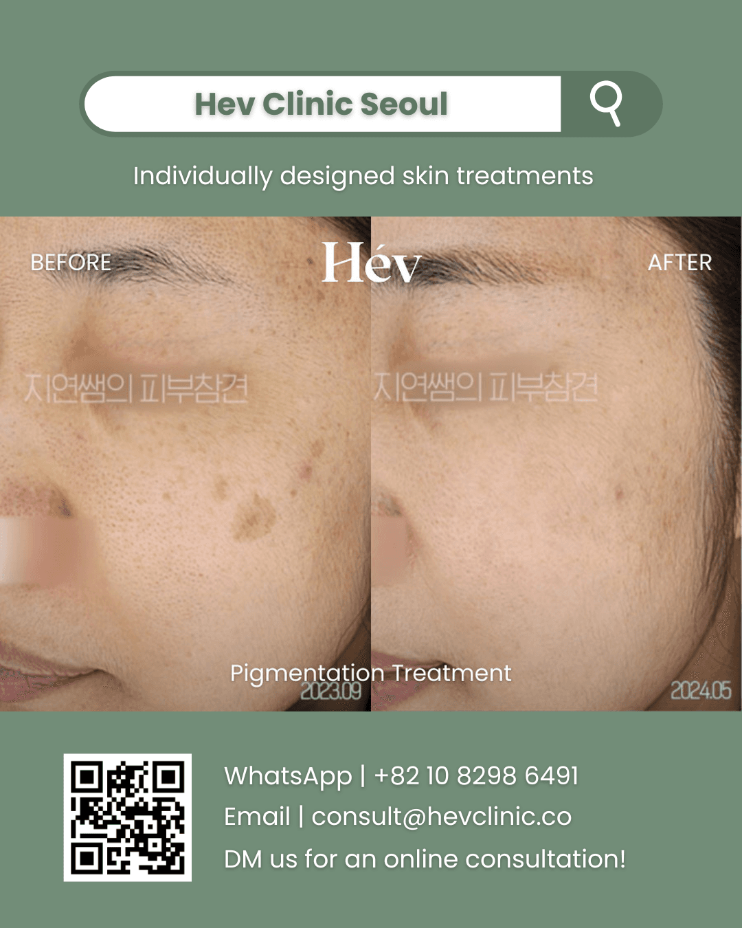 Pigmentation Treatment