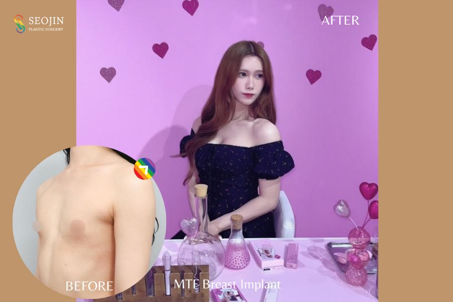 Before and After MTF Surgery