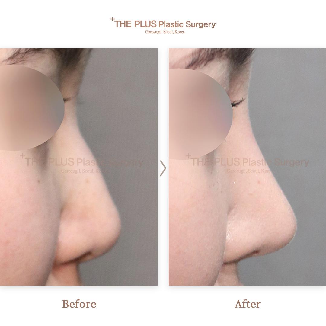 Primary Rhinoplasty & Nose Implant & Nasal Tip Plasty & Ear Cartilage & Septal Cartilage & Nasal Septum Deviation Correction & Sinus Surgery & Nose Osteotomy